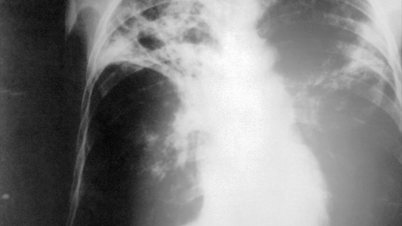 A frontal chest X-ray shows the lungs and rib cage with a bright abnormal area in the upper lung.