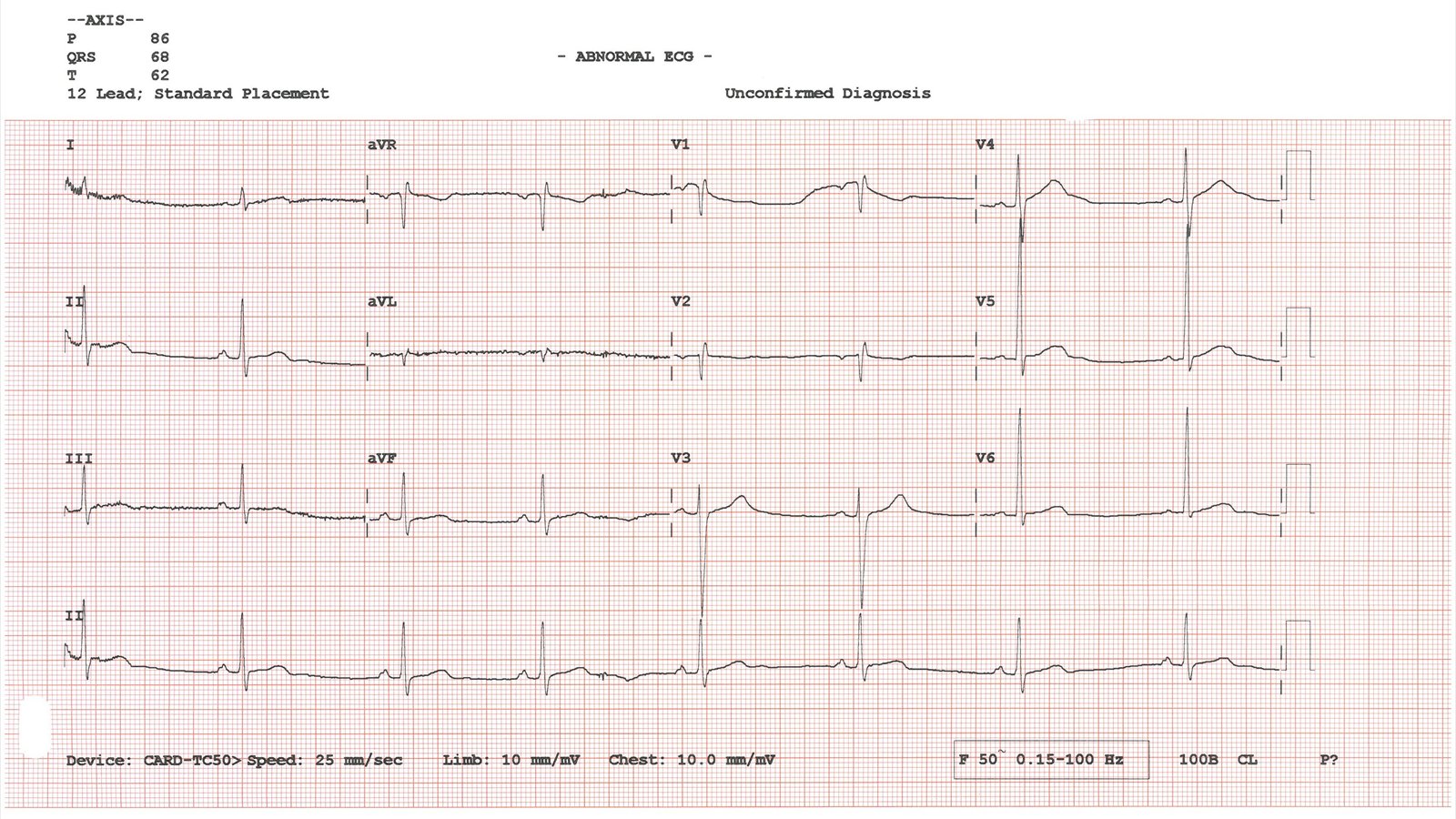 Twelve labeled electrocardiogram traces cross red graph paper beneath automated measurements and an unconfirmed interpretation.